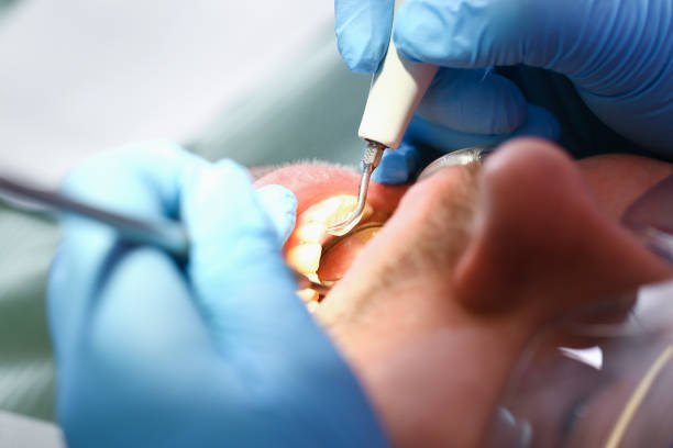 Best Emergency Wisdom Tooth Extraction in Flowery Branch, GA